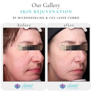 Sun damage left side (2)