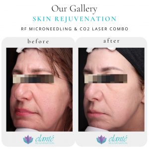 Sun damage left side (3)