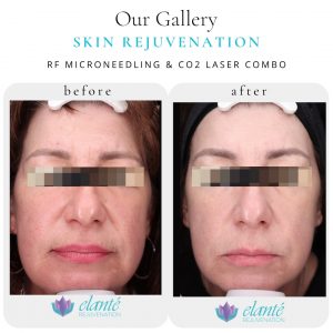 Sun damage left side