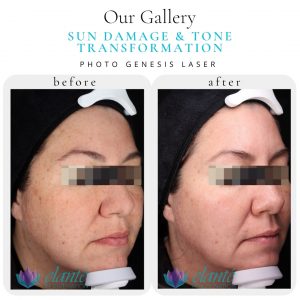 Sun damage left side (4)